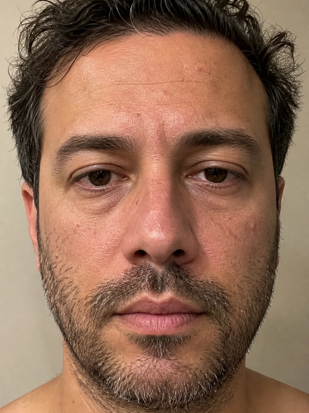 VIP Hydro Facial — before